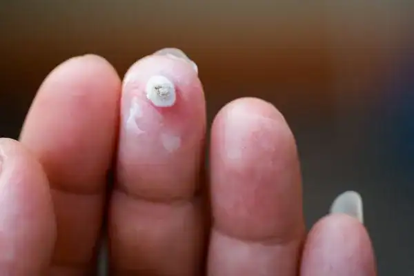 Image of white wart before cryopen treatment Royal Tunbridge Wells