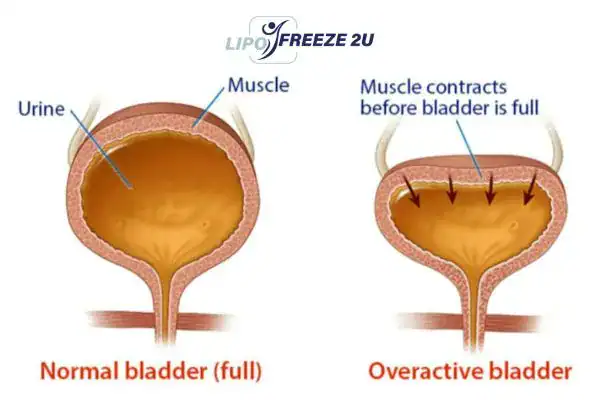 diagram of overactive bladder treatment Royal Tunbridge Wells