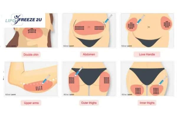 Benefits of Choosing Aqualyx for Fat Reduction Royal Tunbridge Wells