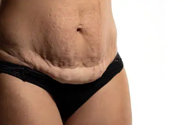 loose skin after weight loss injections Royal Tunbridge Wells