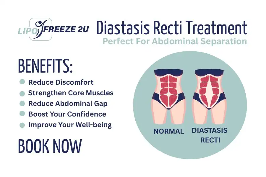 How Long Will It Take to See Improvements in Diastasis Recti Royal Tunbridge Wells