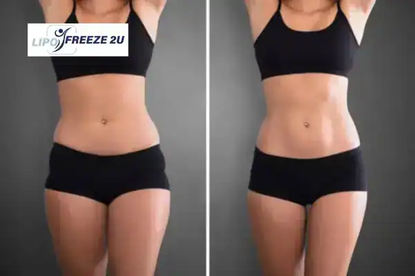 How Can LIPO FREEZE 2U Support Your Post-Pregnancy Body Recovery Royal Tunbridge Wells?