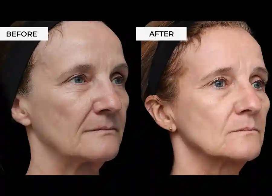 How Many RF Microneedling Sessions Will You Need to See a Difference Royal Tunbridge Wells?