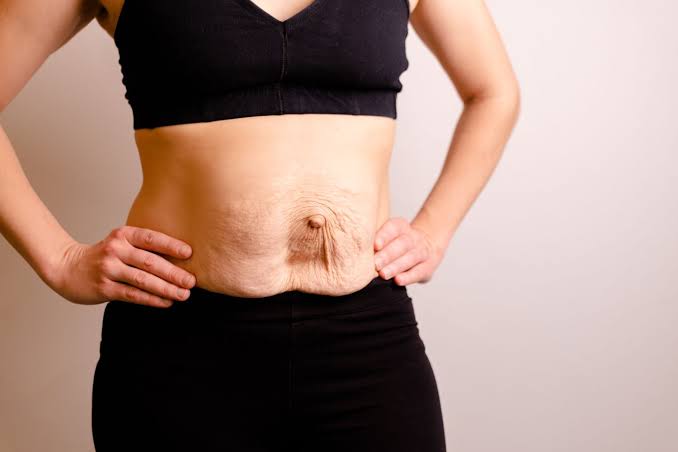 Is Surgery Really the Only Way to Repair Diastasis Recti Royal Tunbridge Wells?