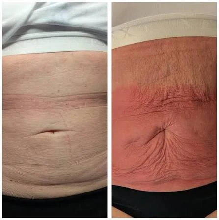 How Does RF Microneedling Improve Crepey, Thin and Uneven Skin Texture Royal Tunbridge Wells?