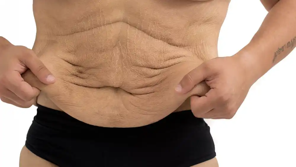 Why Does Weight Loss Medication Leave Some People With Loose or Sagging Skin Royal Tunbridge Wells?